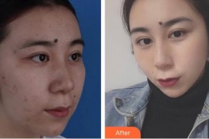 運城華美醫(yī)學美容醫(yī)院陳先才整形價格表附鐳射凈膚案例展示