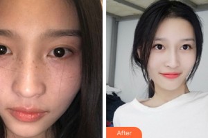 三亞瑞希醫(yī)學美容門診部葉育成整形價格表附皮膚美容案例展示