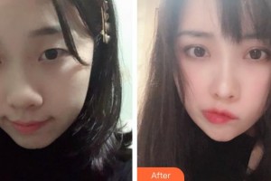 運城市皮膚病醫(yī)院醫(yī)學美容科王國棟整形價格表附激光祛斑案例展示