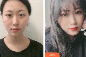 運城光子醫(yī)療美容門診部郝睿鵬整形價格表附激光祛斑案例展示