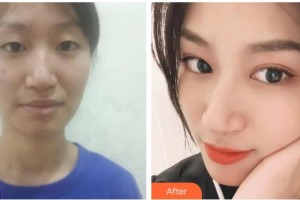 運城麗霞醫(yī)療美容診所李志峰整形價格表附激光祛斑案例展示