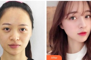 運城華美醫(yī)學美容醫(yī)院徐健帆整形價格表附清潔祛痘案例展示