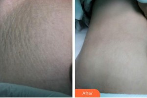 運城海鷗美容外科診所暢海鷗整形價格表附祛妊娠紋案例展示