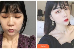 運城麗霞醫(yī)療美容診所孫肖陽整形價格表附去痘印痘坑案例展示