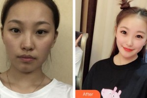 運城愛爾眼科醫(yī)院陳鵬整形價格表附激光祛斑案例展示