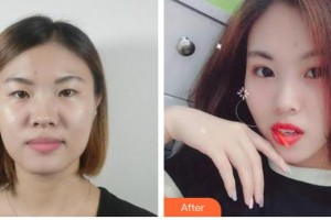 運城愛爾眼科醫(yī)院寧英慧整形價格表附切開雙眼皮案例展示