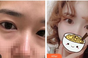 運城愛爾眼科醫(yī)院王寧整形價格表附內(nèi)切祛眼袋案例展示