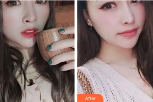 運城愛爾眼科醫(yī)院行磊整形價格表附內(nèi)切祛眼袋案例展示