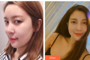 運城愛爾眼科醫(yī)院魏潤梅整形價格表附眼部修復案例展示