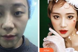 運城愛爾眼科醫(yī)院樊曉娟整形價格表附切開雙眼皮案例展示