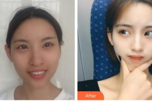 運城愛爾眼科醫(yī)院李冬年整形價格表附眼部綜合案例展示