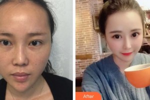 運城愛爾眼科醫(yī)院賈保平整形價格表附眼部修復案例展示