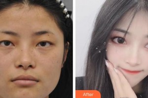 運城愛爾眼科醫(yī)院高巖整形價格表附眼部綜合案例展示