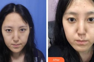 運城市皮膚病醫(yī)院醫(yī)學美容科任璐璐整形價格表附激光去眼袋案例展示