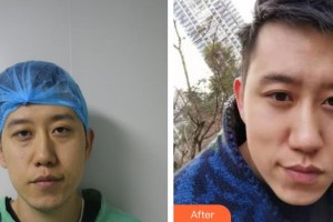 運城市眼科醫(yī)院李愛萍整形價格表附眶隔脂肪釋放案例展示