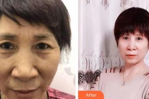 運城市眼科醫(yī)院黃淑芳整形價格表附切眉術(shù)案例展示