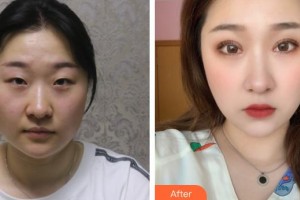 運城市眼科醫(yī)院張建民整形價格表附眼部綜合案例展示