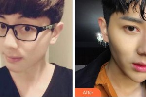 運城市眼科醫(yī)院李麗麗整形價格表附眼部綜合案例展示