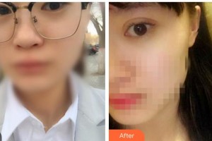 運城愛爾眼科醫(yī)院張小紅整形價格表附切開雙眼皮案例展示