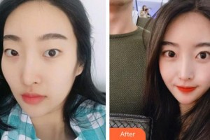 運城市眼科醫(yī)院李曉梅整形價格表附眼部綜合案例展示