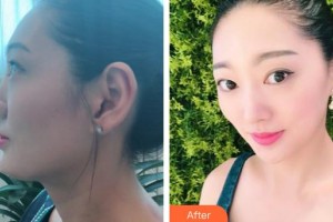 臨汾憶佳星醫(yī)療美容門診部李奕得整形價格表附鼻部綜合案例展示