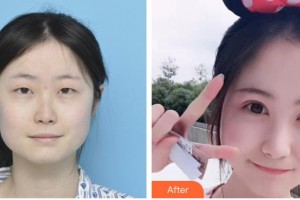 臨汾市堯都區(qū)眼科醫(yī)院張愛當(dāng)整形價格表附切開雙眼皮案例展示