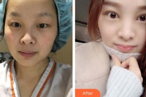 臨汾市堯都區(qū)眼科醫(yī)院楊張榮整形價(jià)格表附開內(nèi)眼角案例展示