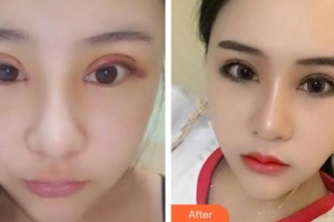 臨汾市堯都區(qū)眼科醫(yī)院王雙喜整形價格表附外切祛眼袋案例展示