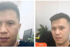 內(nèi)蒙古藍天整形醫(yī)院趙鋼整形價格表附去痘印痘坑案例展示