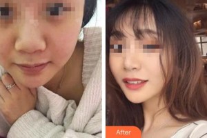 內(nèi)蒙古醫(yī)學(xué)院第三附屬醫(yī)院整形外科路瑋整形價(jià)格表附去痘印痘坑案例展示