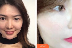 內(nèi)蒙古王成毅醫(yī)療整形美容醫(yī)院烏蘭哈斯整形價格表附美白導(dǎo)入案例展示