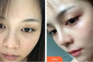 內(nèi)蒙古慕顏醫(yī)療美容門診部劉丹丹整形價格表附激光祛斑案例展示