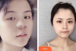 內(nèi)蒙古永泰整形美容醫(yī)院王春燕整形價格表附祛斑祛痣案例展示