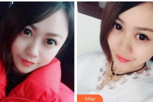 內(nèi)蒙古盛禧醫(yī)療美容門診部史栗豐整形價格表附激光點痣案例展示