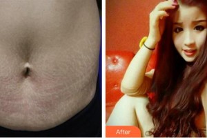 內(nèi)蒙古盛禧醫(yī)療美容門診部程芳芳整形價格表附祛妊娠紋案例展示