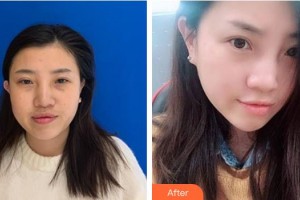 內(nèi)蒙古藍天整形醫(yī)院黃寅守整形價格表附白瓷娃娃案例展示