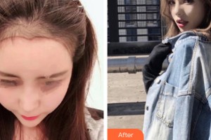 南昌同濟美容醫(yī)院曾慶整形價格表附植發(fā)案例展示