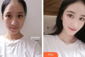 呼和浩特伊思整形?？漆t(yī)院白莉整形價格表附紅藍光祛痘案例展示