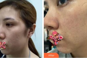 呼和浩特京華醫(yī)療美容診所孫佳琪整形價格表附去痘印痘坑案例展示