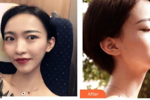 呼和浩特閆小林醫(yī)療美容門診部王月英整形價格表附微針水光例展示