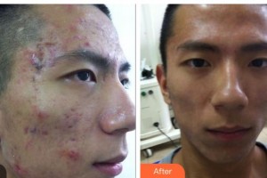 呼和浩特任榮大韓醫(yī)療美容診所李靜整形價格表附紅藍光祛痘案例展示