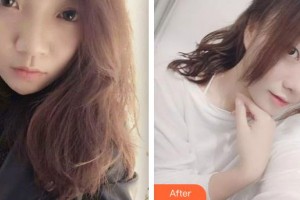 呼和浩特薛瑞蓉康倫醫(yī)療美容診所薛瑞蓉整形價格表附激光祛斑案例展示