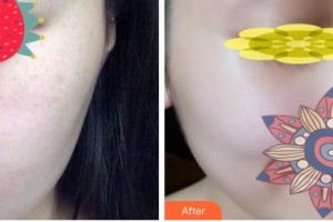 呼和浩特吳老貴醫(yī)學(xué)美容診所吳老貴整形價格表附微針水光案例展示