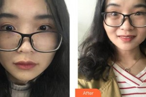 呼和浩特維科美容整形診所李德延整形價格表附清潔祛痘案例展示