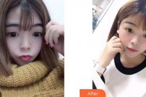 呼和浩特京美醫(yī)療形美容醫(yī)院劉野整形價格表附清潔祛痘案例展示