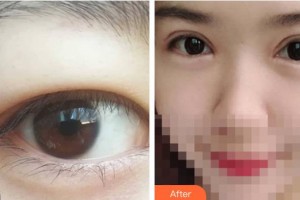 呼和浩特維科美容整形診所辛來整形價(jià)格表附切開雙眼皮案例展示