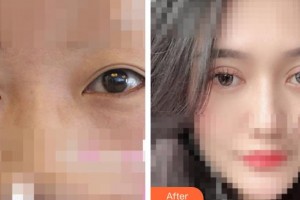 呼和浩特閆德雄醫(yī)療美容診所邊慧娟整形價(jià)格表附眼部綜合案例展示