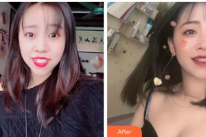 呼和浩特董志新口腔門診部董志新整形價格表附金屬托槽矯正案例展示