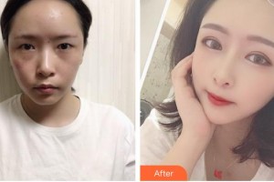 呼和浩特朝聚眼科醫(yī)院崔巍整形價格表附激光去眼袋案例展示