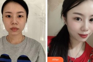 呼和浩特新視界眼科醫(yī)院蔡文全整形價格表附眼部綜合案例展示